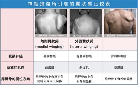 斜肩為什麼不能對著床|認識脊椎側彎常見的4種肩胛骨偏位異常～如何解決翼狀肩、垂肩。